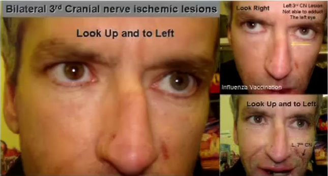 This guy, a schizophrenic, is experiencing bilateral 3rd cranial nerve palsy after receiving an influenza vaccine.