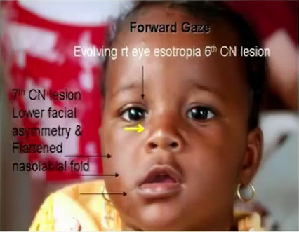 This young girl displays substantial right-side 7th and 6th cranial nerve function deficits.