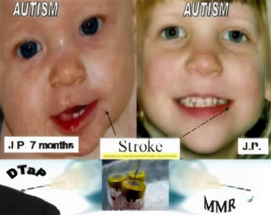 Example of 7th cranial nerve dysfunction in baby and young child.