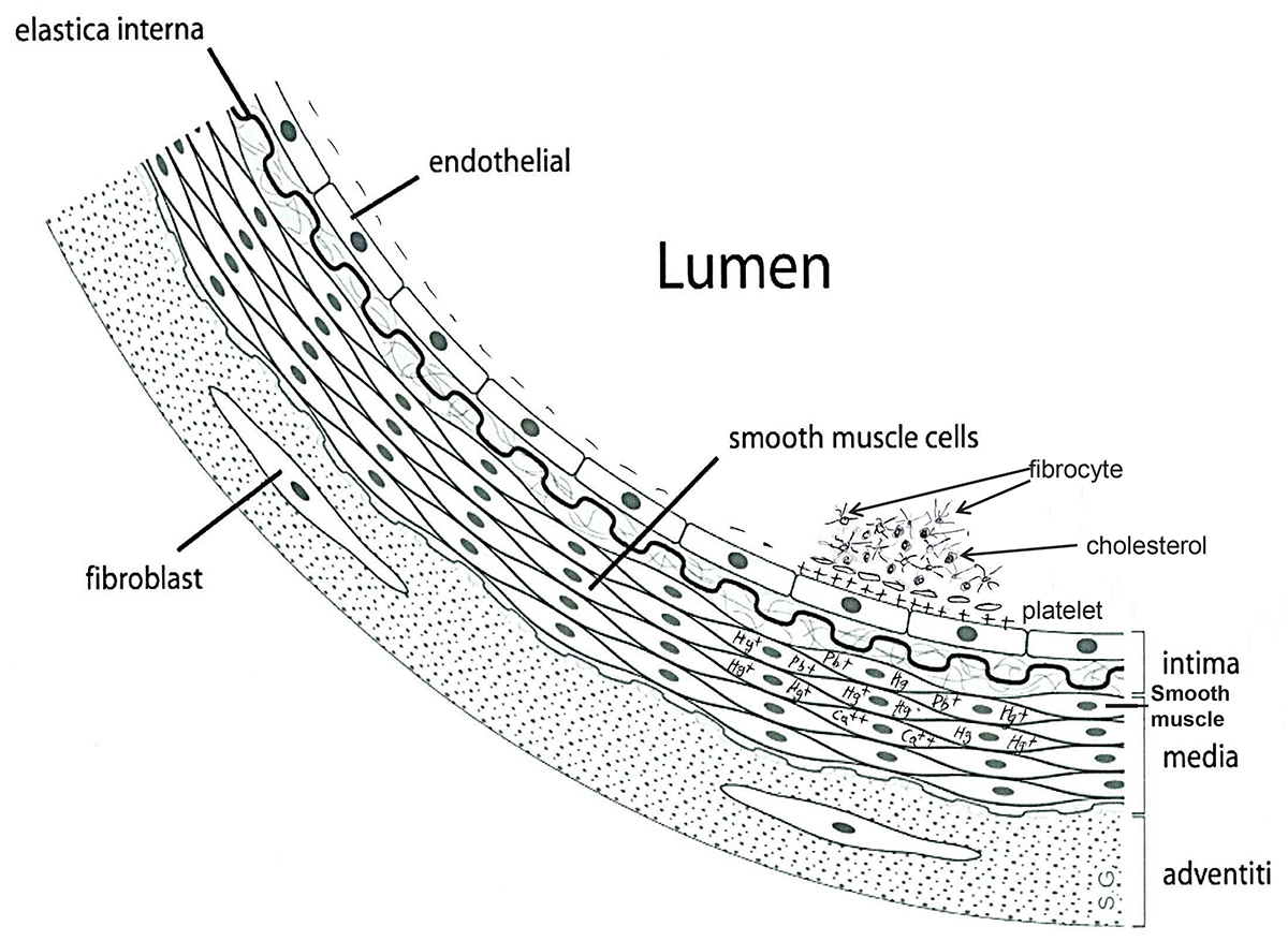 Atherosclerosis by heavy metals 01