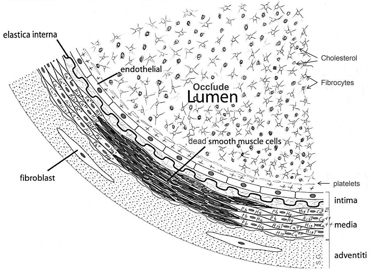 Atherosclerosis by heavy metals 02