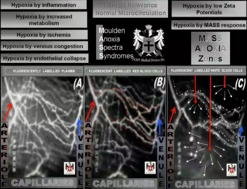 Hypoxia from MASS