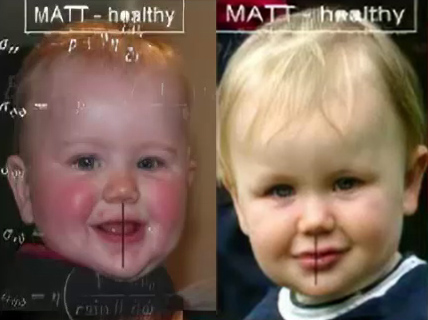 Here’s baby Matt, healthy and happy before vaccination injury.