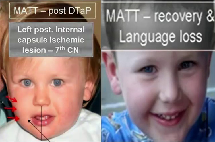 After getting his DTaP shot, Matt displays moderate, right-side 7th cranial nerve damage presenting as a lop-sided smile and a deficient nasolabial fold. It is brain damage caused by interrupted blood flow. He partially recovers between shots (right), with facial asymmetries improving, but losing language skills.