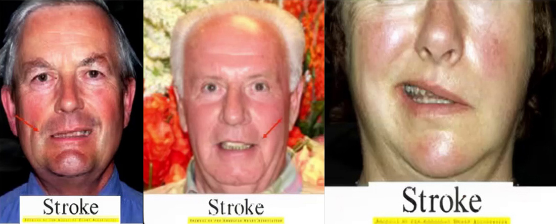 Classic stroke in adults.