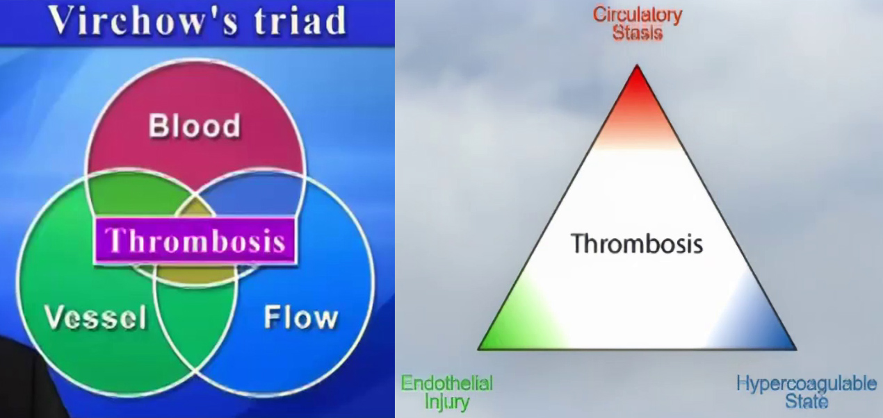 Virchow's Triad